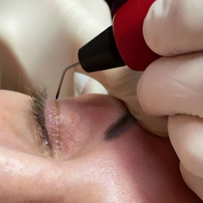 plasma for facial rejuvenation